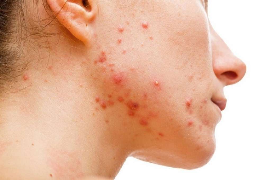 Acne disturbo giovanile