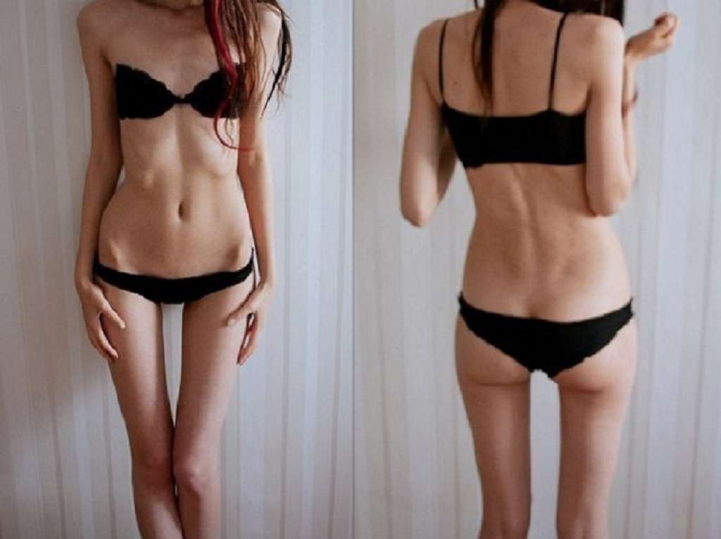 anoressia