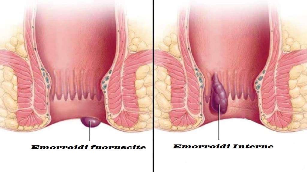 Emorroidi disturbo popolare